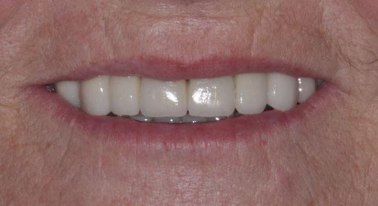 Riabilitazione infiltrazione cariose su denti anteriori