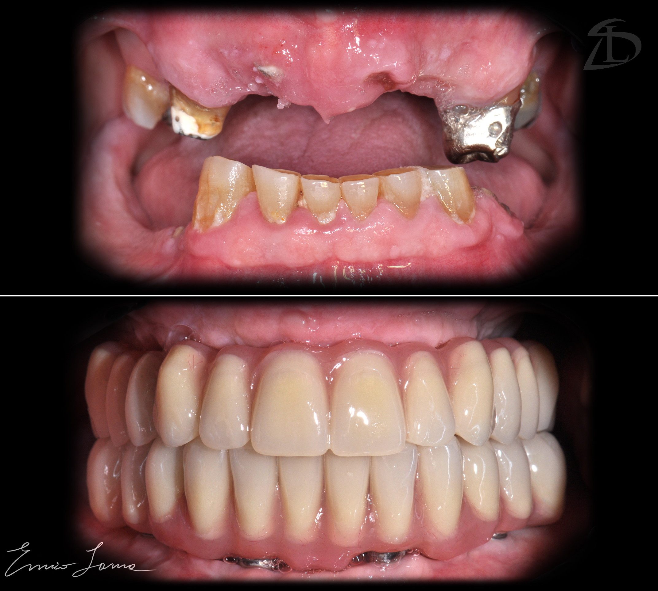 Riabilitazione Arcata dentale superiore ed inferiore con impianti dentali
