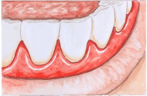parodontologia-gengivite