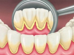 prevenzione-igiene-orale-professionale