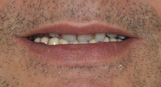Riabilitazione parodontite cronica avanzata